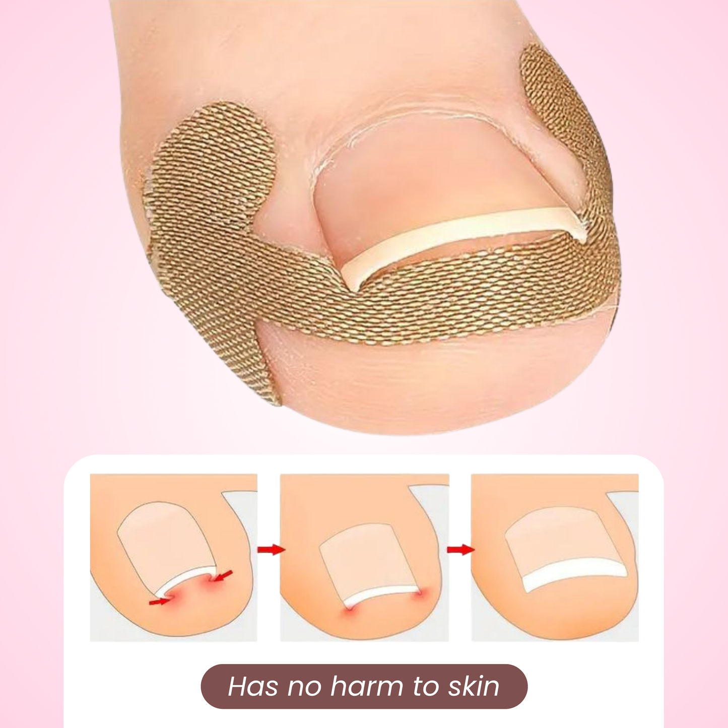 ToeNail - Pro Correction Strips